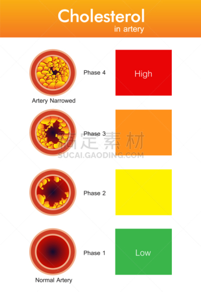 健康保健,胆固醇,动脉,设计师,风险,分离着色,红色,人,血栓症,生病