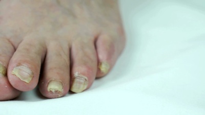 人足部真菌感染指甲