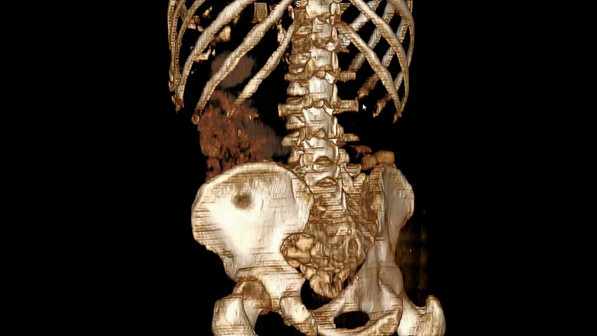 3D MRI扫描中的骨骼扫描