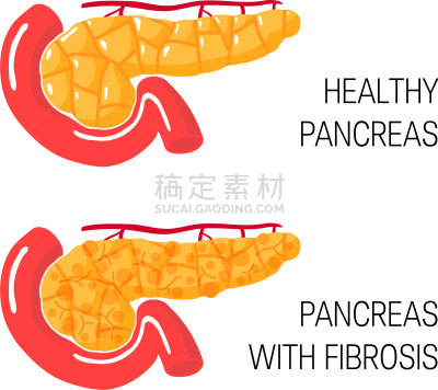 概念,纤维症,锐角,健康保健,人,药,胞囊的,图像,生病
