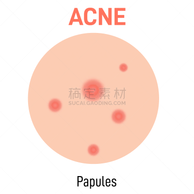 粉刺,果皮,图表,胞囊的,图像,真皮层,美容院,自然美,打字,生病