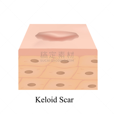 瘢痕瘤,疤,解剖模型,皮肤,人体解剖学,分离着色,健康保健,人,平视角,萎缩的