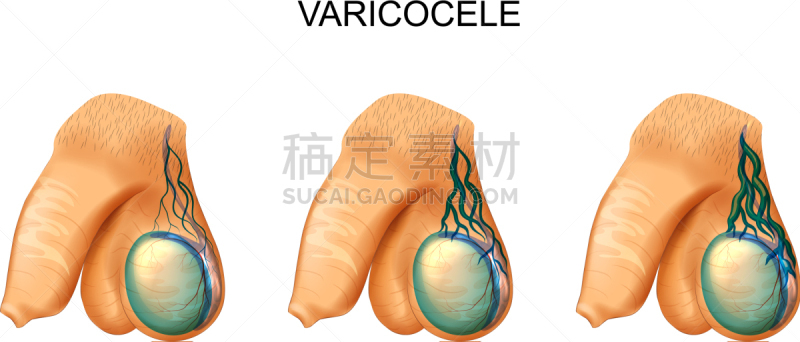 睾丸,输精管,阴囊,泌尿系统,人,男人,导管,贫瘠的,男子气概