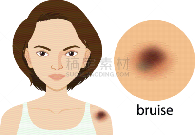 瘀伤,皮肤,女人,生物学,微生物学,健康保健,人,生活方式,生病,教育