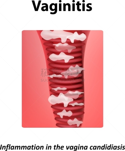 炎症,真菌性口炎,人,图像,女人,人类的生殖器官,矢量,生病