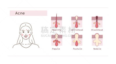 粉刺,健康保健,皮脂,皮肤病学,毛囊,女人,人的脸部,人类腺体,绘画插图,卡通