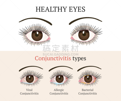 验光师,健康保健,人的眼睛,眼痛,巩膜,红色,人,过敏反应,生病,愤怒