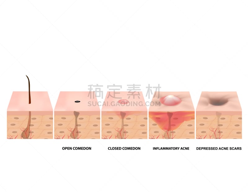 药,疤,绘画插图,炎症,皮肤,矢量,粉刺,分离着色,囊肿,开着的