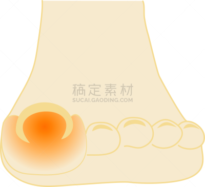 趾甲,痛苦,平衡折角灯,指甲钳,畸形,拇趾囊肿胀,健康保健,背景分离,皮肤病学,鞋子