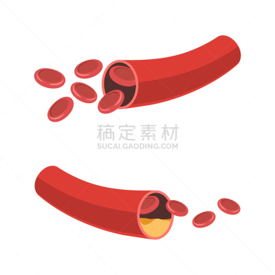 动脉,狭窄的,健康保健,药,脂肪细胞,冠状动脉,动脉硬化症,不健康食物,心肌梗塞,绘画插图