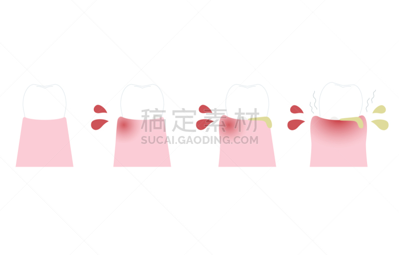 绘画插图,牙周病,顺序,舞台,横截面,医疗流程,医疗图,病毒,白色,不卫生的