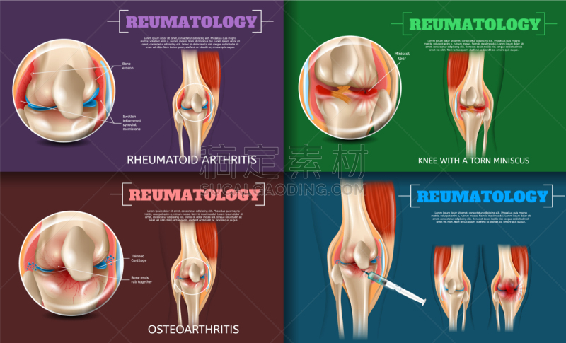 健康保健,三维图形,风湿病,半月状软骨,风湿性关节炎,症状,韧带,写实,讨论