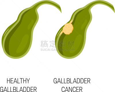 健康保健,癌症,胆囊,概念,胆汁,顺序,胃,人类消化系统,白色