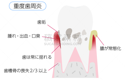 绘画插图,牙周病,认真的,舞台,肿胀的,口腔卫生,健康保健,龋齿,生物膜生物,牙医