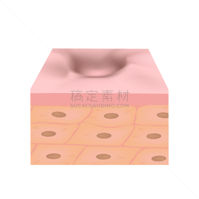 皮肤,矢量,疤,绘画插图,粉刺,解剖模型,分离着色,萎缩的,健康保健,药