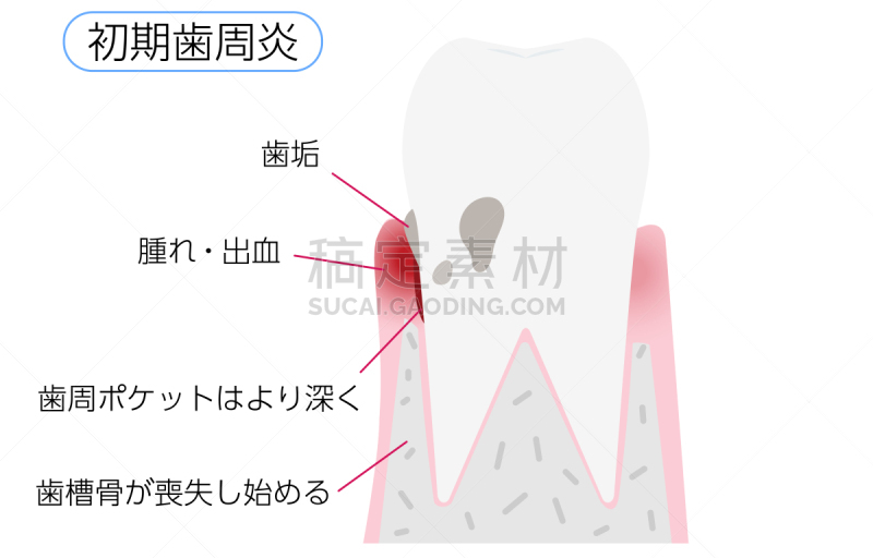 绘画插图,牙周病,早晨,舞台,肿胀的,口腔卫生,健康保健,龋齿,生物膜生物,牙医