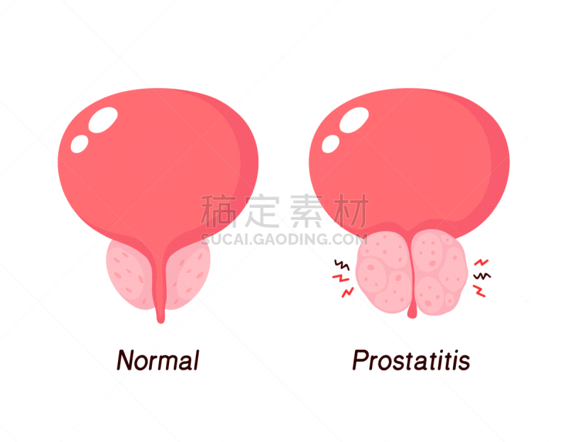 良性的,前列腺,健康保健,尿液,乌克兰,图像