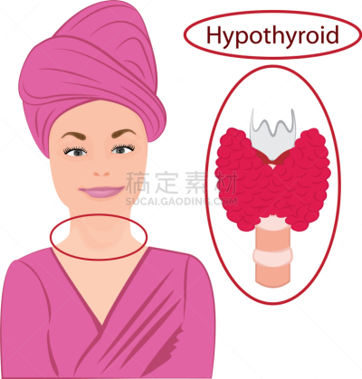 Goiter,内分泌系统,甲状腺,巨大的,健康保健,人,碘,生病