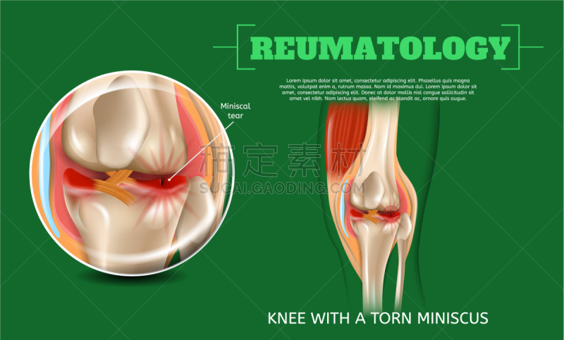 撕破的,三维图形,膝,半月状软骨,风湿病,信息图表,健康保健,写实,扭伤