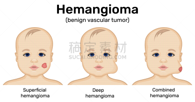 绘画插图,血管瘤,生物学,医生,症状,健康保健,红色,斑点,良性肿瘤,药