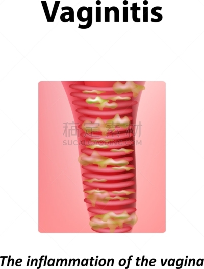 炎症,人,图像,酵母,人类的生殖器官,矢量,子宫颈,生病