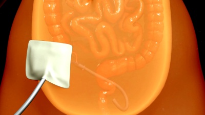 腹膜透析