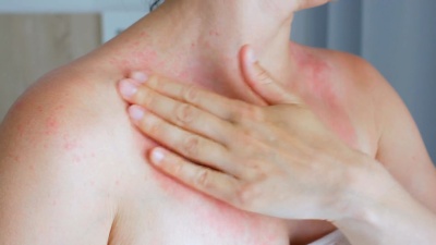女人用手、脖子抓痒。颈部红斑过敏牛皮癣昆虫叮咬。疟疾。晒伤。晒伤
