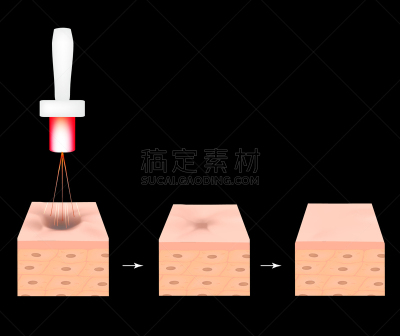药,疤,绘画插图,激光,皮肤,矢量,粉刺,解剖模型,萎缩的,酸