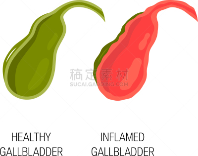 健康保健,炎症,胆囊,概念,胆汁,顺序,胃,人类消化系统,白色