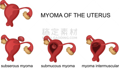 健康保健,人,子宫颈内的,肿瘤学,癌症,图像,女人,Endometrial,生病