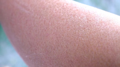 宏图 成年女性腿部极度脱水的白色皮肤剥离层
