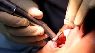 牙医磨牙病人的牙齿用金刚石涂层的弹性圆形喷嘴