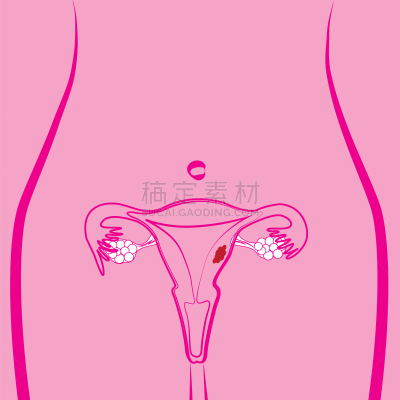 健康保健,人,图表,有月经,宫颈巴氏涂片,图像,女人,Endometrial,生病