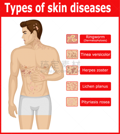 症状,癣菌,男人,皮肤病学,Herpes Zoster,图像,疙瘩,Viral Infection,生病,打字