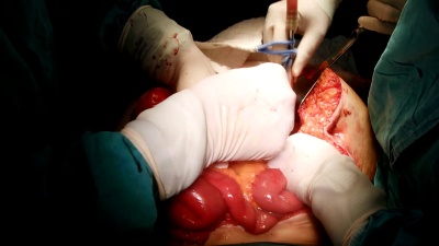 外科医生用生理盐水冲洗腹腔