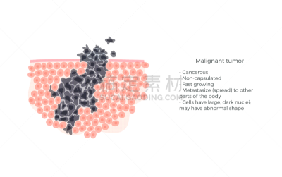 分离着色,癌症,肿瘤,生物学,信息图表,健康保健,显微镜,人,基础的，基本的,生病
