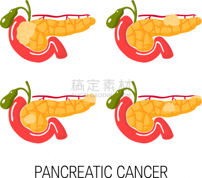 健康保健,概念,胰腺,白色,分离着色,人,药,肿瘤学,生病