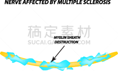 髓鞘,轴突,生物学,健康保健,有髓鞘的,整形器具,神经科学