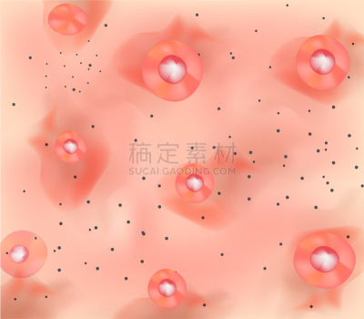 粉刺,炎症,皮肤,三个物体,舞台,毛孔,真皮层,疤,发展,美容