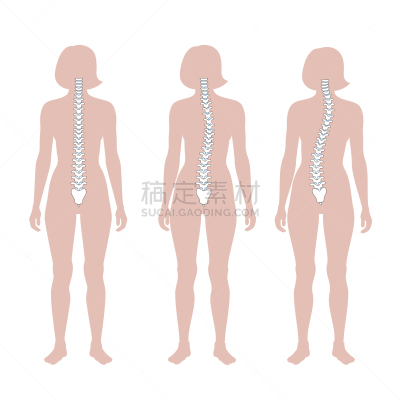 绘画插图,矢量,脊柱侧凸,生物学,畸形,有序,健康保健,姿态,背景分离,人类骨架