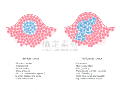 癌症,良性肿瘤,良性的,基础的，基本的,肿瘤学,矢量,细菌,脱氧核糖核酸,生病