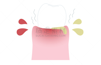 绘画插图,牙周病,认真的,舞台,肿胀的,口腔卫生,健康保健,龋齿,生物膜生物,牙医