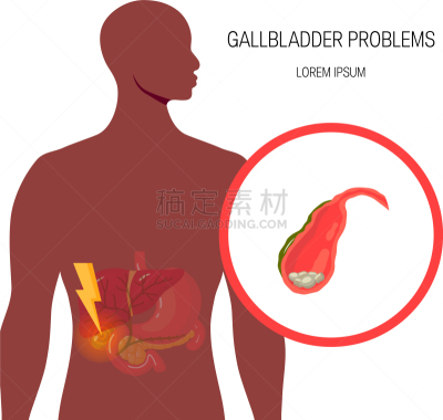 胆汁,健康保健,导管,人类消化系统,膀胱,胆囊,胃,人,男人