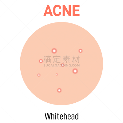 粉刺,皮肤,健康保健,人,图表,胞囊的,图像,美容院,打字,生病