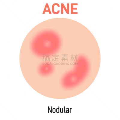 粉刺,果皮,图表,胞囊的,图像,真皮层,美容院,自然美,打字,生病