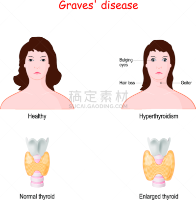 甲状腺肿,有毒物质,墓穴,健康保健,药,癌症,损失,脖子,女人,人的脸部