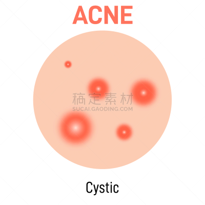 胞囊的,粉刺,果皮,图表,图像,真皮层,美容院,自然美,打字,生病
