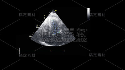 经食管超声检查心脏图像。