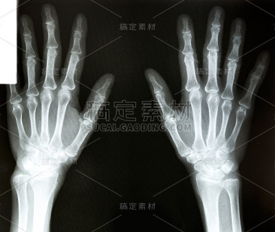 胶片x射线扫描人