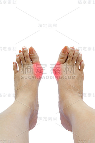 拇外翻，足部拇外翻